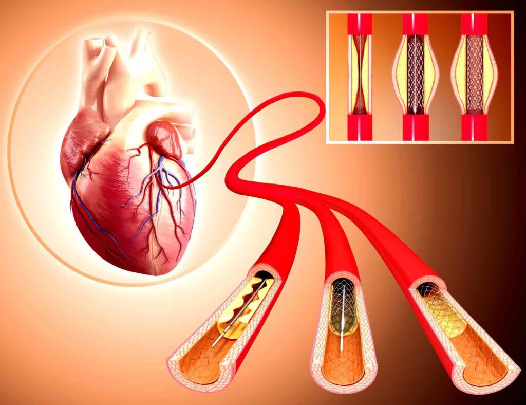 Coronary Angiography & Angioplasty